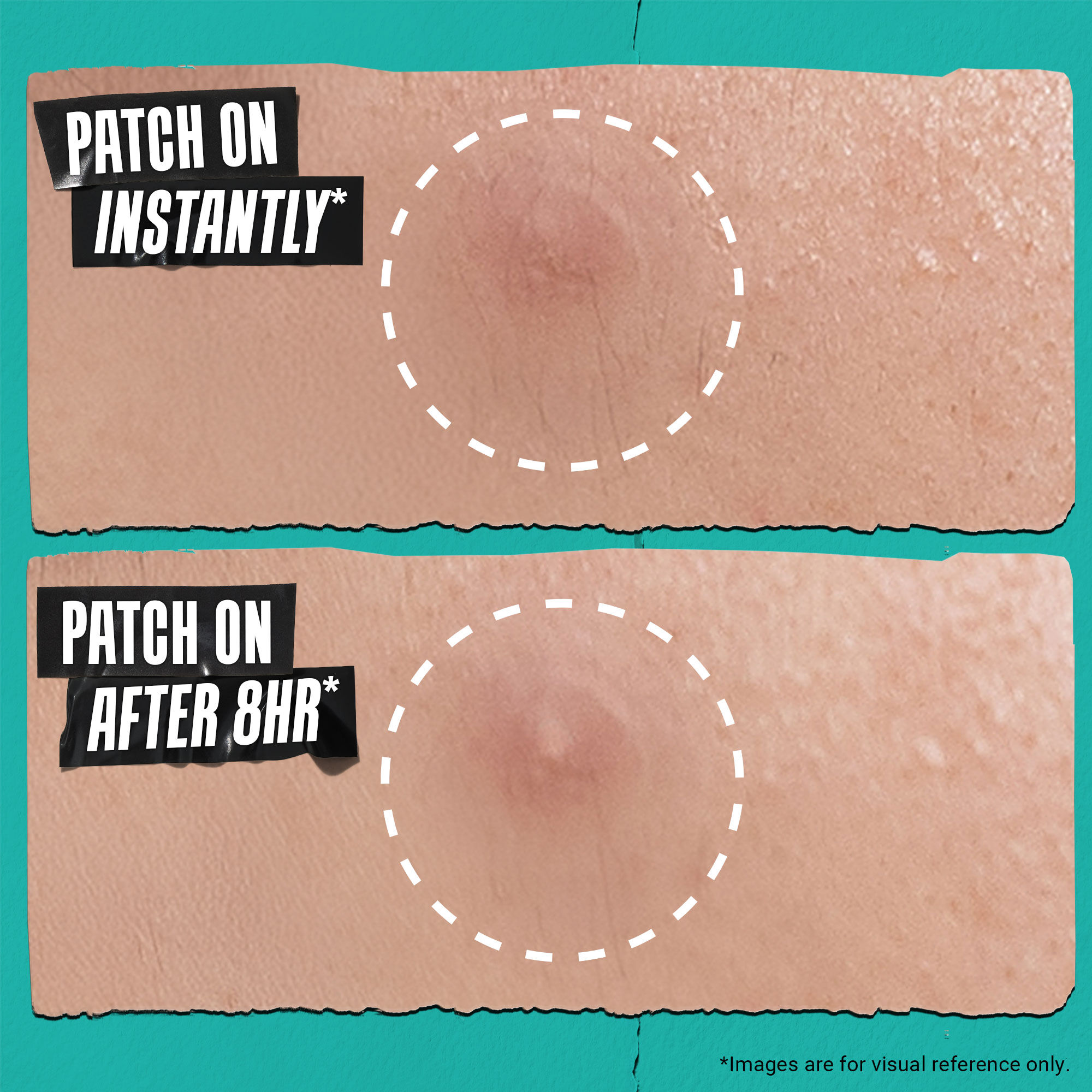 Truly Targeted Overnight Blemish Patch — Targeted Physical